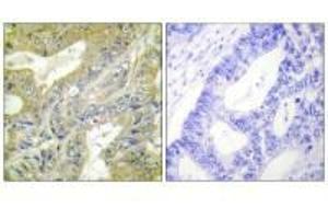 Immunohistochemistry analysis of paraffin-embedded human colon carcinoma tissue using HEXB antibody. (HEXB anticorps  (C-Term))