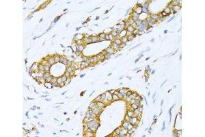 Immunohistochemistry of paraffin-embedded Human breast cancer using VARS Polyclonal Antibody at dilution of 1:100 (40x lens).