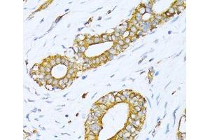 Immunohistochemistry of paraffin-embedded Human breast cancer using VARS Polyclonal Antibody at dilution of 1:100 (40x lens). (VARS anticorps)