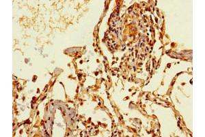 Immunohistochemistry of paraffin-embedded human lung cancer using ABIN7172158 at dilution of 1:100 (THRSP anticorps  (AA 41-144))