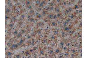 Detection of GAL8 in Human Liver cancer Tissue using Polyclonal Antibody to Galectin 8 (GAL8)