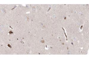ABIN6272964 at 1/100 staining Human brain cancer tissue by IHC-P. (MPV17 anticorps  (Internal Region))