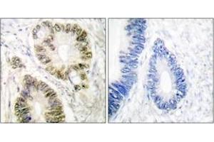 Immunohistochemistry analysis of paraffin-embedded human colon carcinoma, using Cyclin E1 (Phospho-Thr395) Antibody.