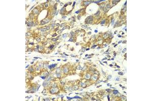 Immunohistochemistry of paraffin-embedded human gastric cancer using DLST antibody (ABIN6130277, ABIN6139665, ABIN6139667 and ABIN6217240) at dilution of 1:100 (40x lens).