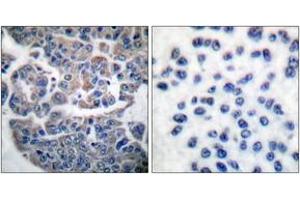 Immunohistochemistry analysis of paraffin-embedded human breast carcinoma, using eEF2K (Phospho-Ser366) Antibody. (EEF2K anticorps  (pSer366))