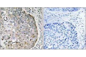 Immunohistochemistry analysis of paraffin-embedded human lung carcinoma tissue, using MRRF Antibody.