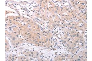 The image on the left is immunohistochemistry of paraffin-embedded Human lung cancer tissue using ABIN7131156(SPATA16 Antibody) at dilution 1/25, on the right is treated with fusion protein. (SPATA16 anticorps)