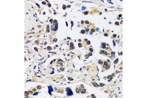 Immunohistochemistry of paraffin-embedded human lung cancer using CCDC59 antibody (ABIN7266440) at dilution of 1:100 (40x lens).