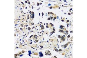 Immunohistochemistry of paraffin-embedded human lung cancer using CCDC59 antibody (ABIN7266440) at dilution of 1:100 (40x lens). (CCDC59 anticorps  (AA 1-241))