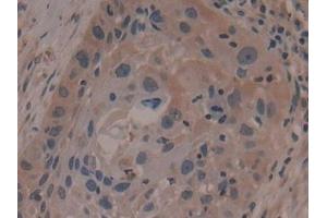Detection of ANO6 in Human Lung cancer Tissue using Polyclonal Antibody to Anoctamin 6 (ANO6)