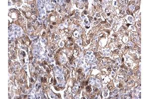 IHC-P Image MAF1 antibody detects MAF1 protein at nucleus on human endometrial carcinoma by immunohistochemical analysis. (MAF1 anticorps  (Center))