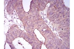 Immunohistochemical analysis of paraffin-embedded rectum cancer tissues using EGFR mutant mouse mAb with DAB staining.