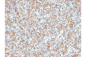Formalin-fixed, paraffin-embedded human Ewing's sarcoma stained with anti-Vimentin antibody (VM1170). (Vimentin anticorps)