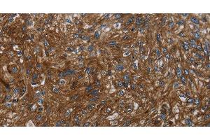 Immunohistochemistry of paraffin-embedded Human esophagus cancer tissue using KISS1R Polyclonal Antibody at dilution 1:30 (KISS1R anticorps)