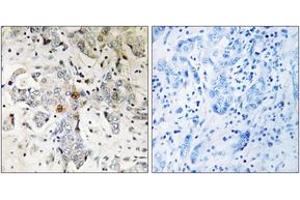 Immunohistochemistry analysis of paraffin-embedded human breast carcinoma tissue, using ZCCHC17 Antibody. (ZCCHC17 anticorps  (AA 51-100))