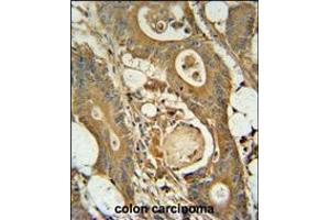 GCNT3 antibody immunohistochemistry analysis in formalin fixed and paraffin embedded human colon carcinoma followed by peroxidase conjugation of the secondary antibody and DAB staining.