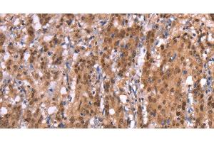 Immunohistochemistry of paraffin-embedded Human gasrtic cancer tissue using AMER1 Polyclonal Antibody at dilution 1:40