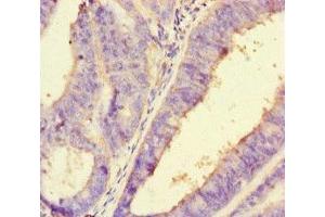 Immunohistochemistry of paraffin-embedded human endometrial cancer using ABIN7162730 at dilution of 1:100 (PDLIM5 anticorps  (AA 268-404))