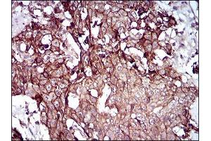 Immunohistochemical analysis of paraffin-embedded esophageal cancer tissues using DSG3 mouse mAb with DAB staining. (Desmoglein 3 anticorps  (AA 55-159))