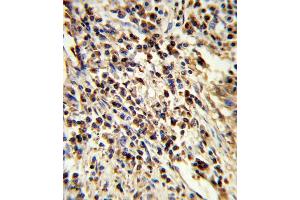 Formalin-fixed and paraffin-embedded human lung carcinoma reacted with PS Antibody (Center), which was peroxidase-conjugated to the secondary antibody, followed by DAB staining. (PSMA7 anticorps  (AA 100-126))