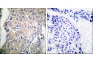 Immunohistochemistry analysis of paraffin-embedded human breast carcinoma tissue, using CPI17 alpha (Ab-38) Antibody.