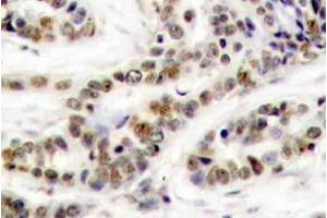 Immunohistochemistry (IHC) analyzes of p-CREB-1 antibody in paraffin-embedded human breast carcinoma tissue. (CREB1 anticorps  (pSer129))