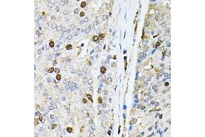 Immunohistochemistry of paraffin-embedded human prostate cancer using PNKP antibody (ABIN5974039) at dilution of 1/100 (40x lens). (PNKP anticorps)