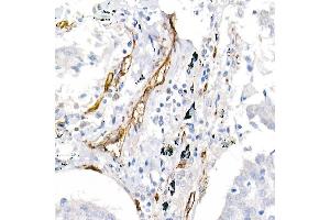Immunohistochemistry of paraffin-embedded human lung cancer using CD146/MCAM Rabbit pAb (ABIN6127568, ABIN6143621, ABIN6143622 and ABIN6218100) at dilution of 1:25 (40x lens). (MCAM anticorps  (AA 447-646))