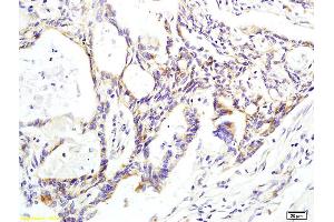 Formalin-fixed and paraffin embedded human colon carcinoma labeled with Anti phospho-CK II beta (Ser209) Polyclonal Antibody, Unconjugated (ABIN872284) at 1:200 followed by conjugation to the secondary antibody and DAB staining. (CSNK2B anticorps  (pSer209))