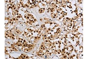 The image on the left is immunohistochemistry of paraffin-embedded Human thyroid cancer tissue using ABIN7190953(HIST1H2AB Antibody) at dilution 1/20, on the right is treated with synthetic peptide. (HIST1H2AB anticorps)