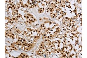 The image on the left is immunohistochemistry of paraffin-embedded Human thyroid cancer tissue using ABIN7190953(HIST1H2AB Antibody) at dilution 1/20, on the right is treated with synthetic peptide.