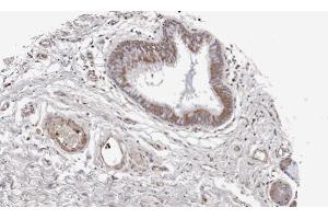 IHC-P Image Immunohistochemical analysis of paraffin-embedded lung SCC xenograft, using WNT11, antibody at 1:100 dilution.