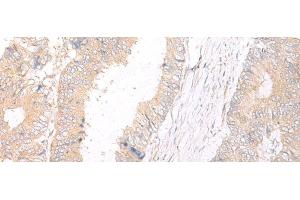 Immunohistochemistry of paraffin-embedded Human colorectal cancer tissue using HLA-C Polyclonal Antibody at dilution of 1:25(x200) (HLA-C anticorps)