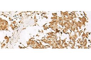 Immunohistochemistry of paraffin-embedded Human lung cancer tissue using PSMD12 Polyclonal Antibody at dilution of 1:40(x200)