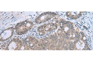 Immunohistochemistry of paraffin-embedded Human gastric cancer tissue using CCNG1 Polyclonal Antibody at dilution of 1:30(x200) (Cyclin G1 anticorps)