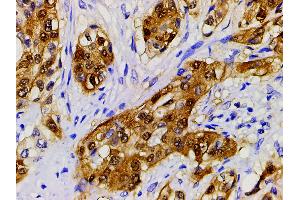 ABIN6267443 at 1/200 staining human esophageal carcinoma tissue sections by IHC-P.