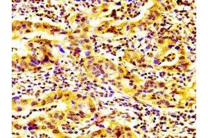 IHC image of ABIN7163593 diluted at 1:600 and staining in paraffin-embedded human bladder cancer performed on a Leica BondTM system.