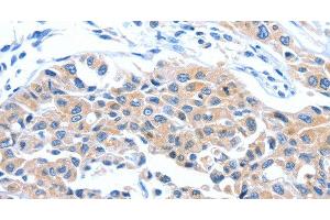 Immunohistochemistry of paraffin-embedded Human lung cancer tissue using ARL11 Polyclonal Antibody at dilution 1:50 (ARL11 anticorps)