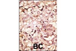 Formalin-fixed and paraffin-embedded human cancer tissue reacted with the primary antibody, which was peroxidase-conjugated to the secondary antibody, followed by AEC staining.