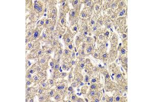 Immunohistochemistry of paraffin-embedded Human liver injury using MPP2 antibody at dilution of 1:100 (x400 lens). (MPP2 anticorps)