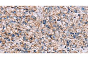 Immunohistochemistry of paraffin-embedded Human prostate cancer tissue using ADAM12 Polyclonal Antibody at dilution 1:40
