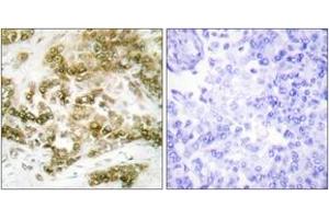 Immunohistochemistry analysis of paraffin-embedded human breast carcinoma tissue, using TBX15/18 Antibody. (T-Box 15/18 anticorps  (AA 161-210))