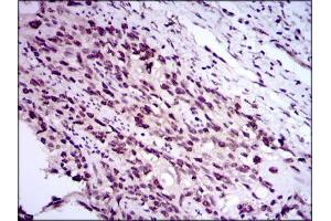 Immunohistochemical analysis of paraffin-embedded esophageal cancer tissues using E2F1 mouse mAb with DAB staining.
