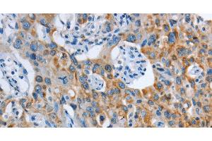 Immunohistochemistry of paraffin-embedded Human lung cancer tissue using ASL Polyclonal Antibody at dilution 1:35