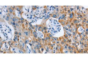 Immunohistochemistry of paraffin-embedded Human lung cancer tissue using ASL Polyclonal Antibody at dilution 1:35 (ASL anticorps)