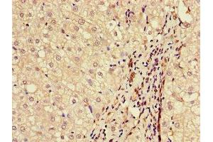 Immunohistochemistry of paraffin-embedded human liver cancer using ABIN7145589 at dilution of 1:100 (BAAT anticorps  (AA 313-400))