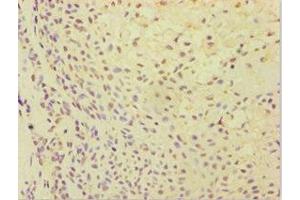 Immunohistochemistry of paraffin-embedded human breast cancer using ABIN7144870 at dilution of 1:100