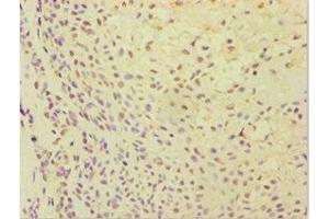 Immunohistochemistry of paraffin-embedded human breast cancer using ABIN7144870 at dilution of 1:100 (ATP5J anticorps  (AA 1-108))
