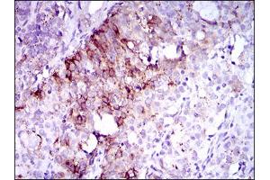 Immunohistochemical analysis of paraffin-embedded cervical cancer tissues using FLT3 mouse mAb with DAB staining. (FLT3 anticorps  (AA 930-991))