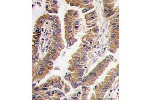 Formalin-fixed and paraffin-embedded human lung carcinoma tissue reacted with Bmp4 antibody (N-term), which was peroxidase-conjugated to the secondary antibody, followed by DAB staining.